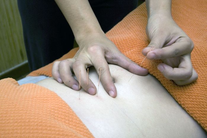 image of acupuncture